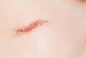 아름다운 흉터□ 송향옥